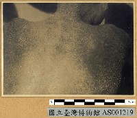 藏品(新幾內亞風土病寫真-疊瓦癬 (渦紋癬))的圖片